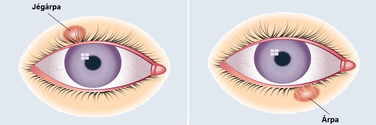 Kisebb szemészeti műtétek A felső szemhéjak papilloma kezelése