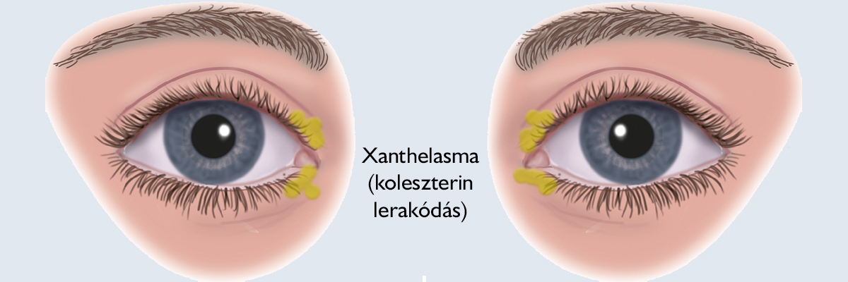Magas koleszterinszintű látás Látás helyreállítási műtét kor
