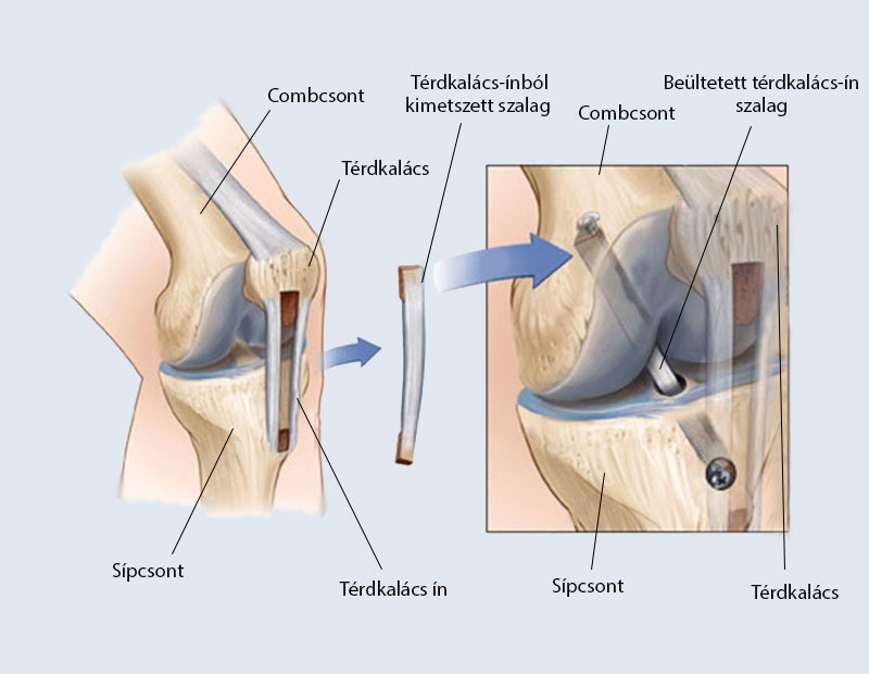 asztalfiók tünet jelentése hogyan lehet kezelni a csípőízület chondrosisát