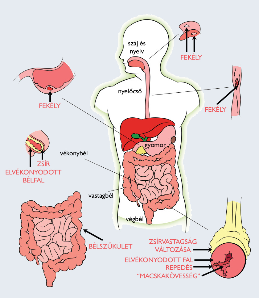 Crohn-betegség 2 oka, 10 tünete és 6 kezelési módja