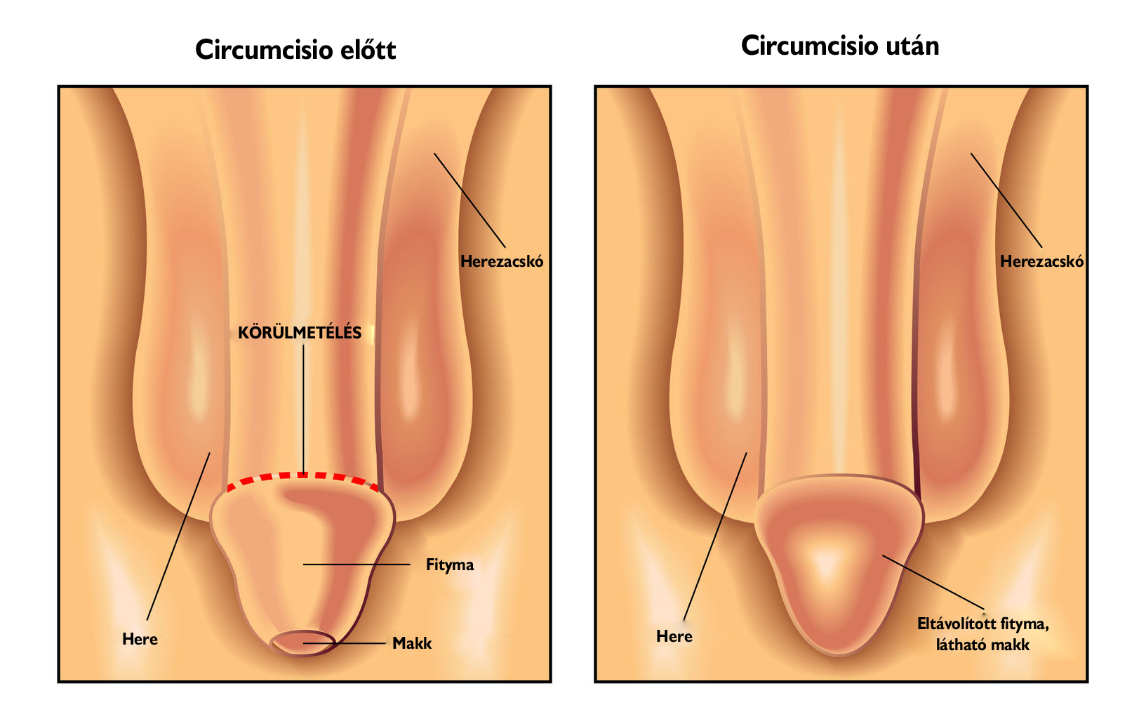 Urológiai műtét - Circumcisio - Körüllmetélés - Medicover Magánkórház