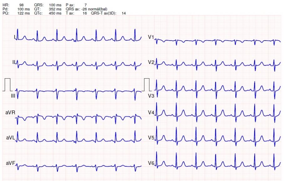 magas vérnyomás EKG terheléssel