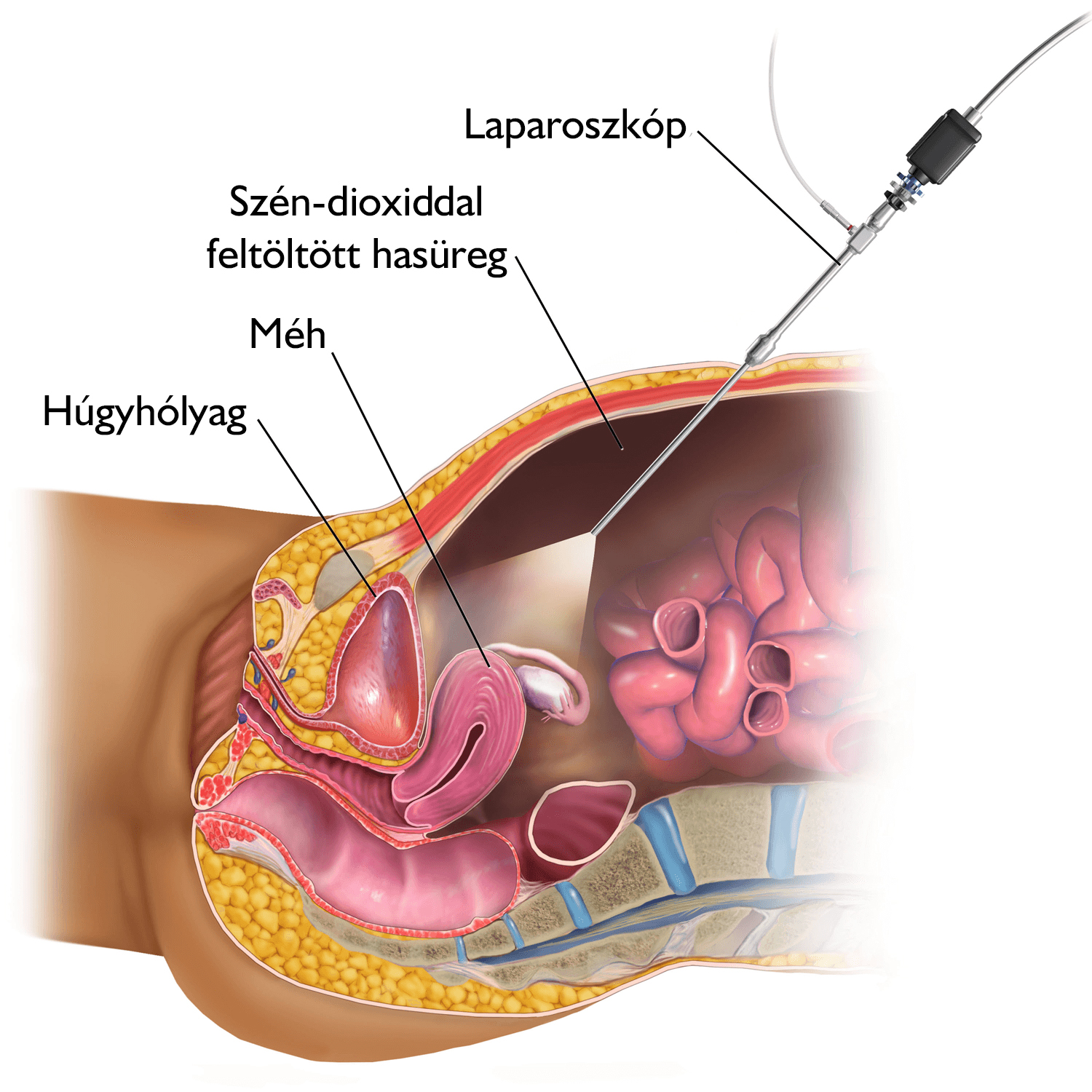 Anti-inkontinencia műtét (TOT)