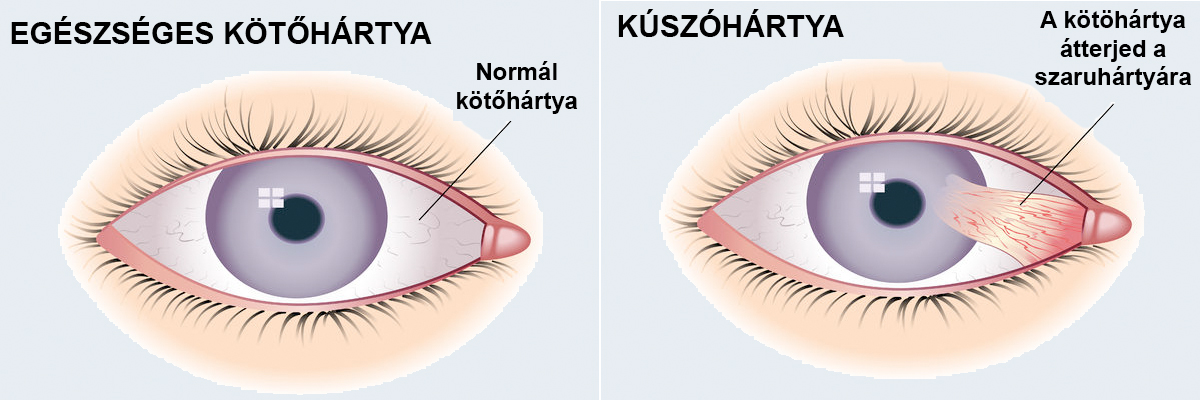 szemészeti fúzió d-vitamin látás