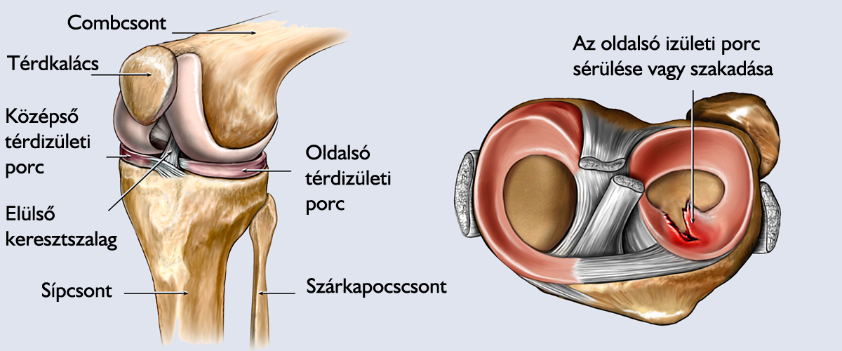 Mi történik az térd artroszkópia (artroszkópos térdműtét) során?