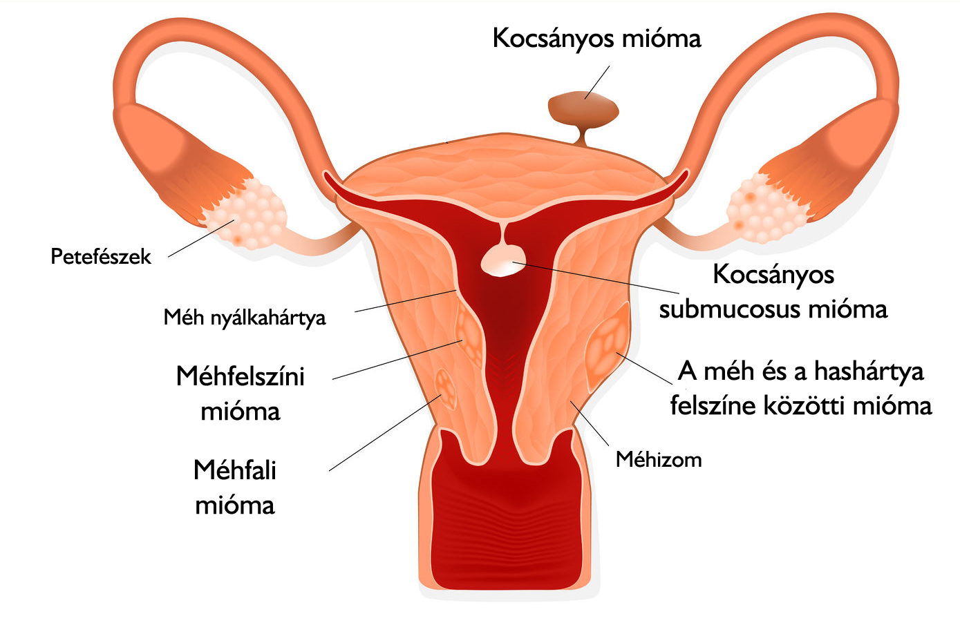 Súlycsökkenés az endometriosis laparoszkópia után - Endometriózis műtét- mire számítsak?