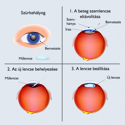 szürkehályog myopia műtét