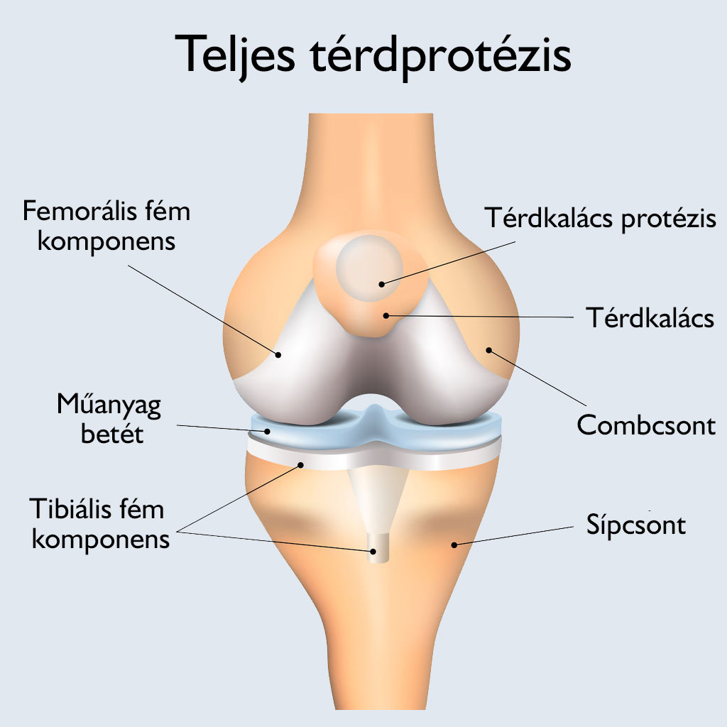 térdízületi fájdalom a protézisek után)