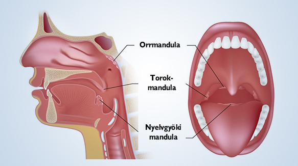 Torokmandula műtét (Tonsillectomia)