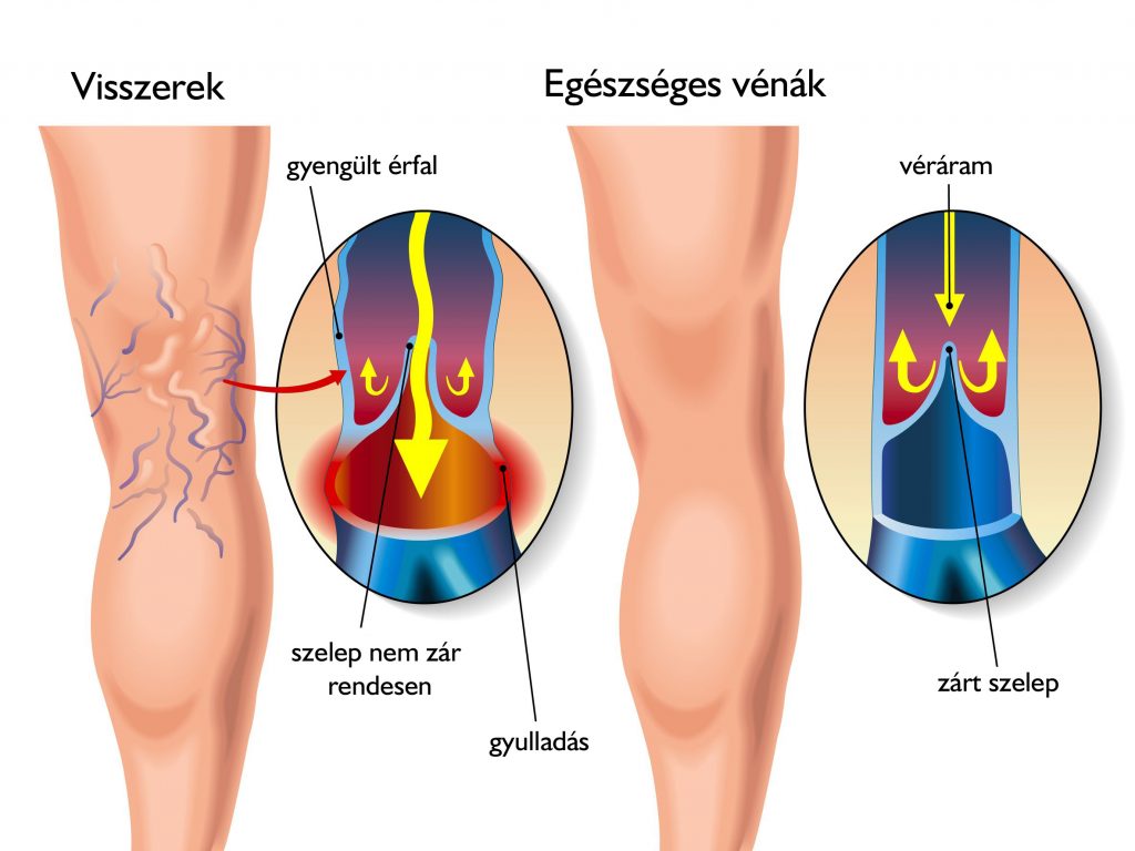 Szkleroterápia (sclerotherapia) - Dr. Sepa György érsebész