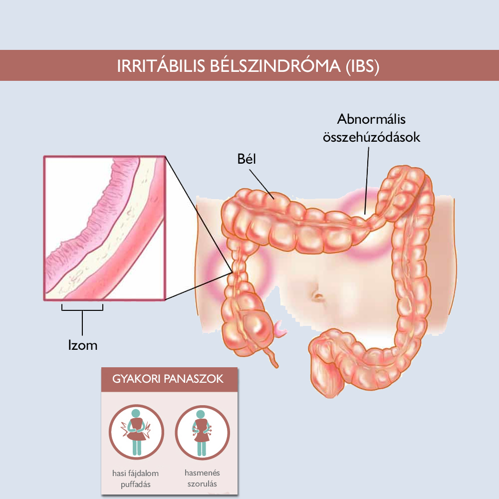 Az irritábilis bél szindróma (IBS)