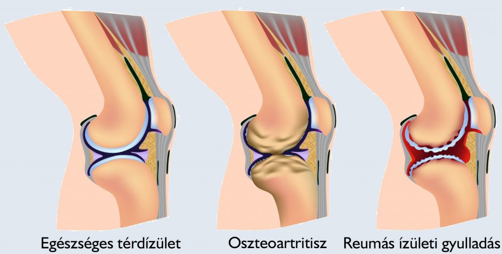 fájó fájdalom a térdben láb és gerinc kezelés