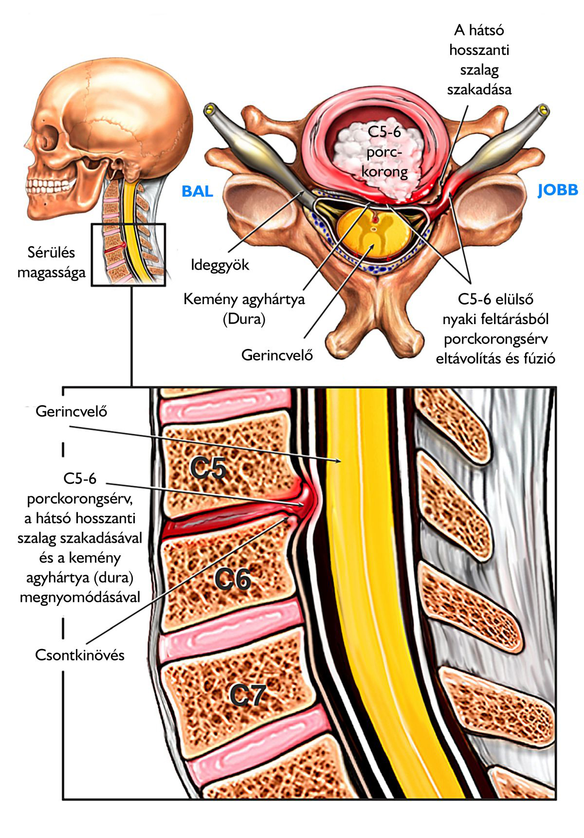 A gerincsérv és porckorongsérv részletesen, érthetően - Gerincfórum