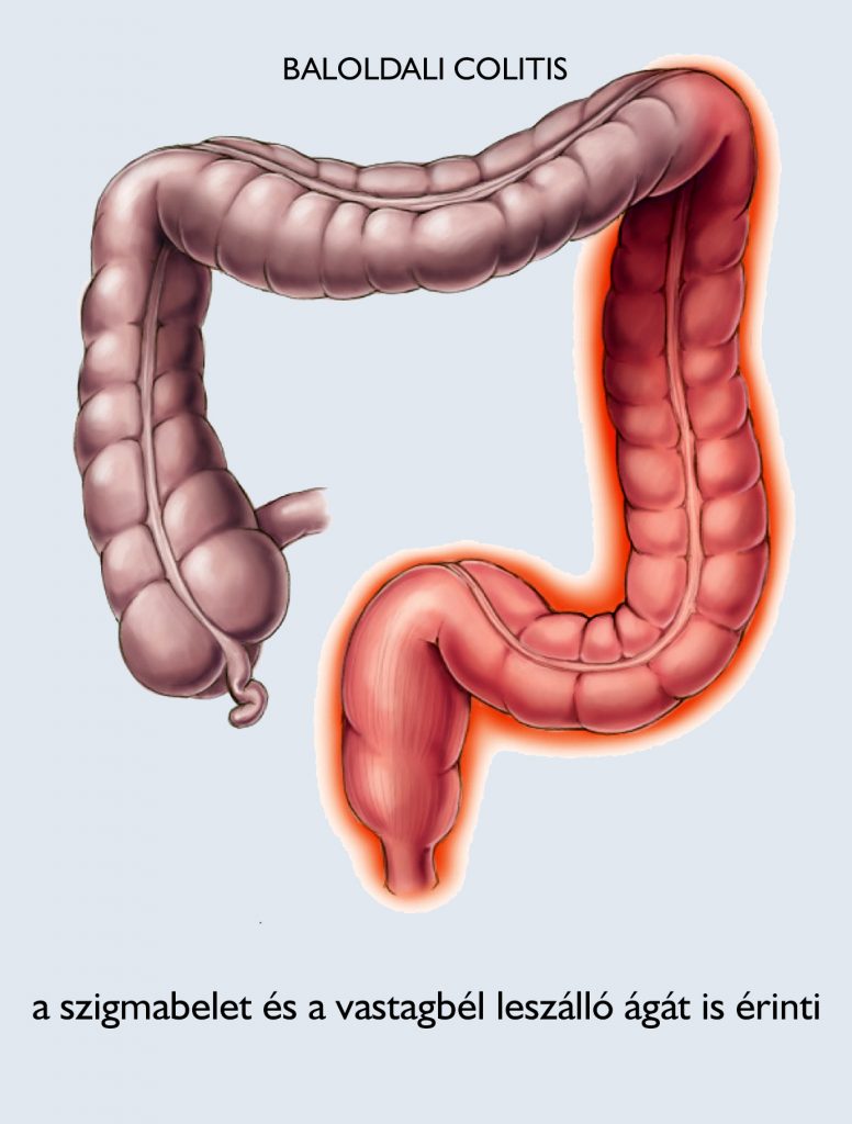 Mi a gyulladásos bélbetegség (IBD) - Magyarországi Crohn-Colitises Betegek Egyesülete