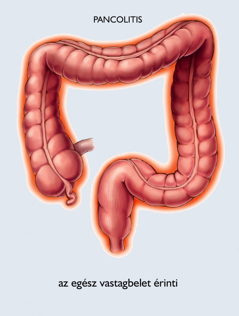 3 természetes illóolaj Crohn-betegség tünetei ellen – Jópofa Bolt