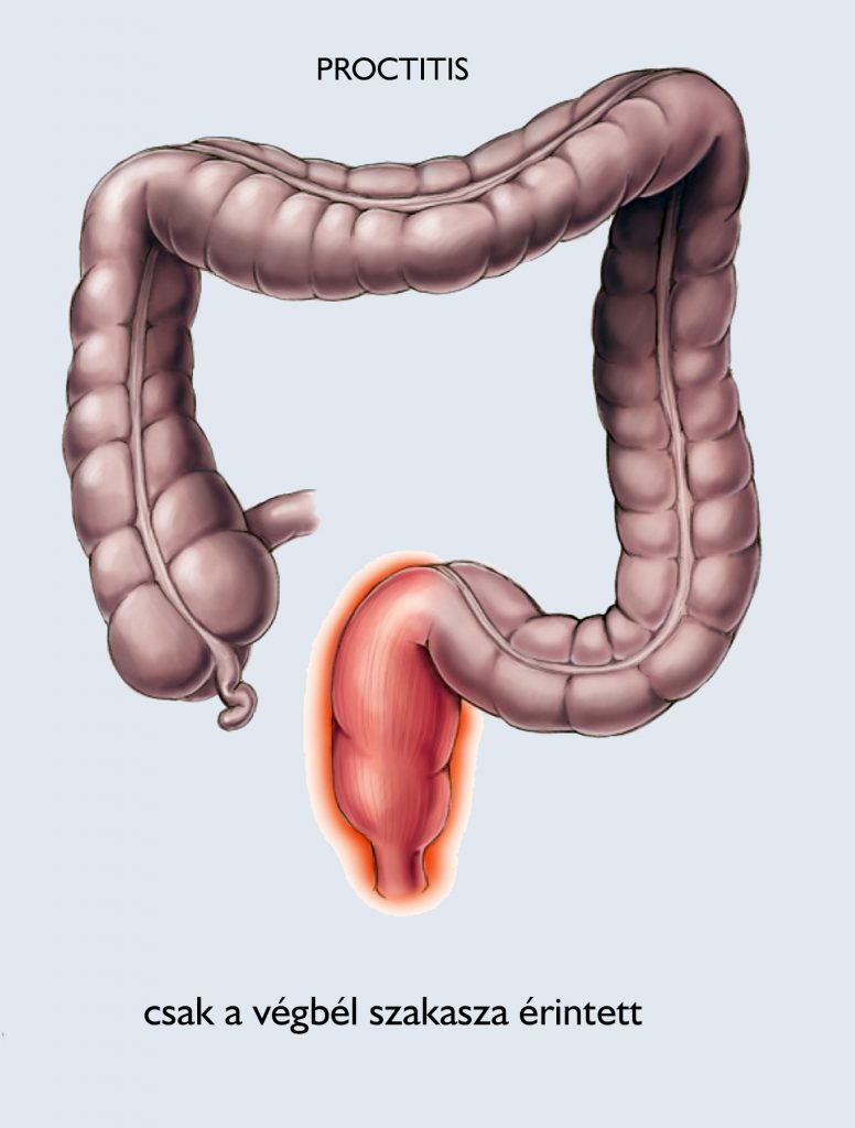 Súlycsökkenés és bél inkontinencia, A fekélyes vastagbélgyulladás (colitis ulcerosa)