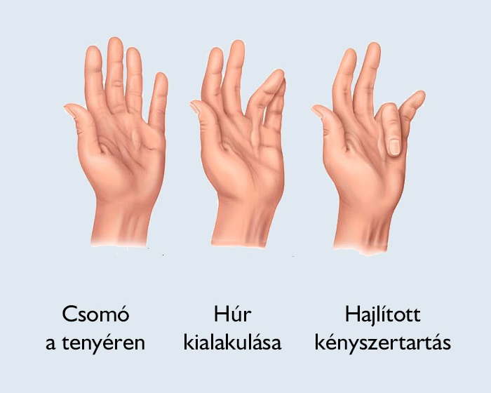 deformáló kéz osteoarthritis)