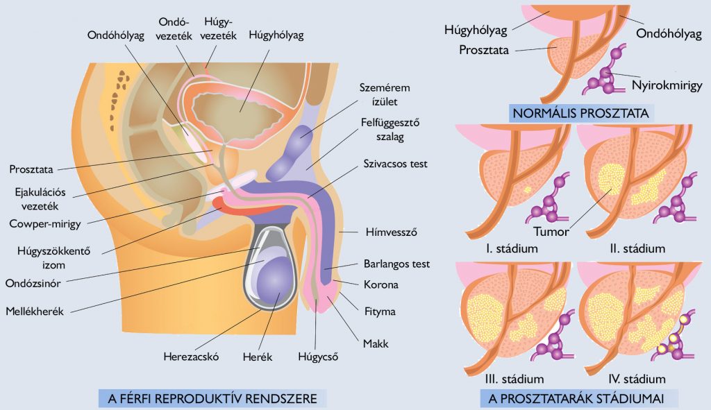 bladder neck involvement prostate cancer hogyan alakul ki krónikus prosztatitis