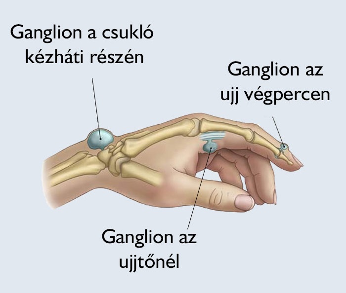 Ganglionok előfordulása a kézen