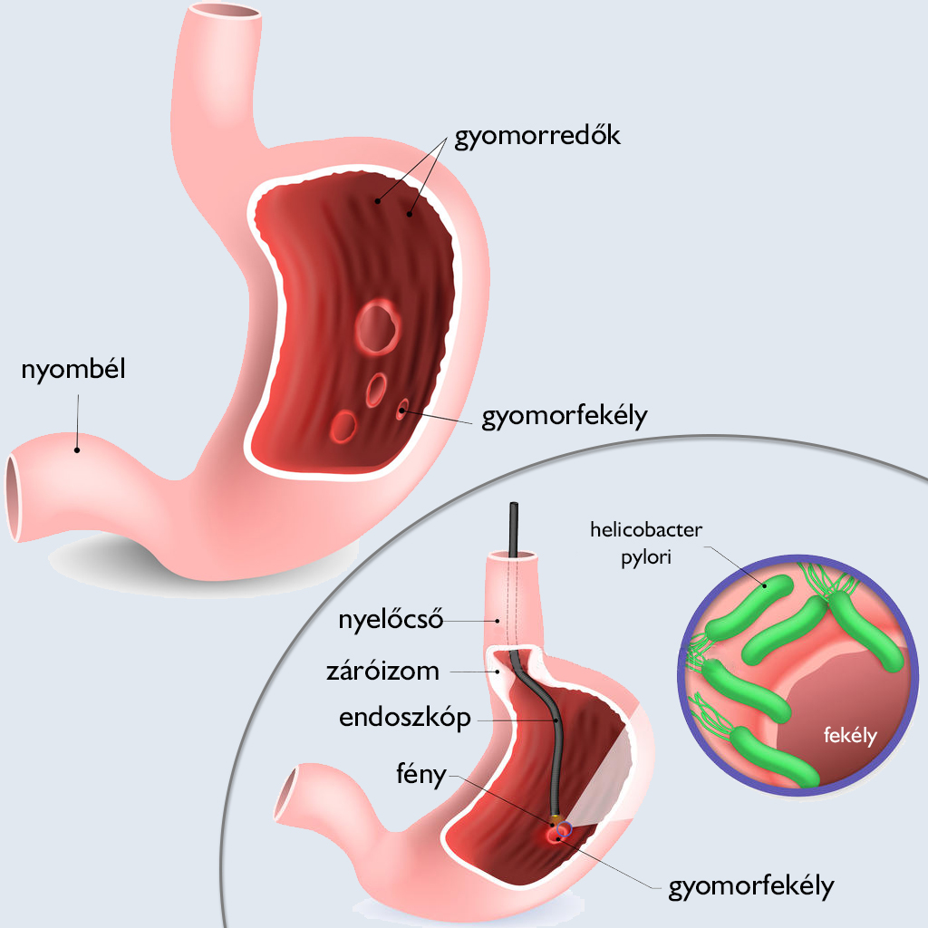 A gyomorrák tünetei és rizikófaktorai