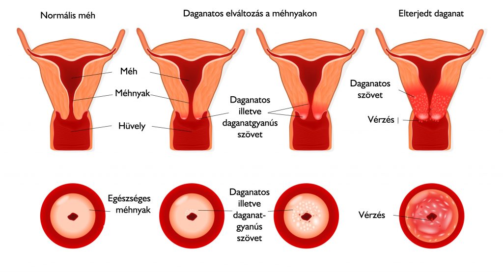 különbség a papilloma és a mióma között condyloma nőknél következményei