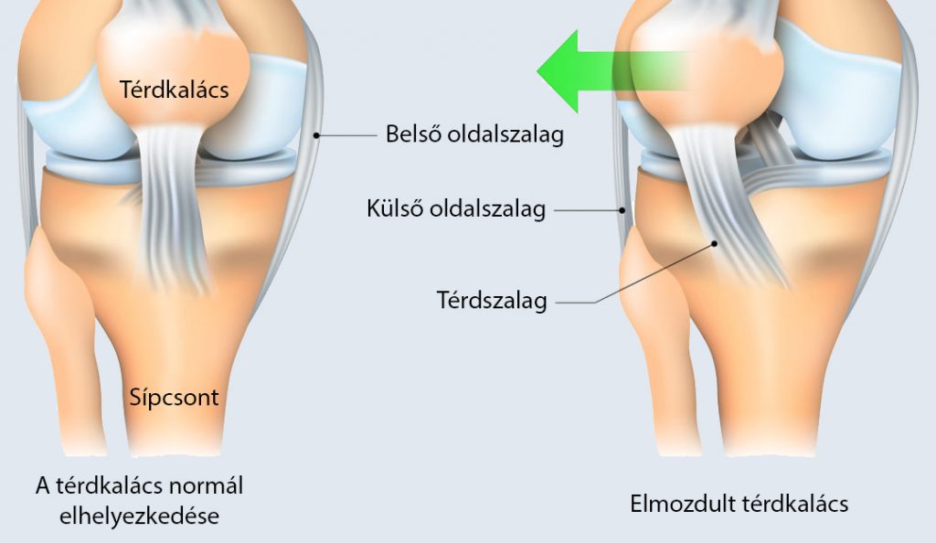 boka ízület ligamentumainak károsodása mi az 1. fokú kezelés lábízülete