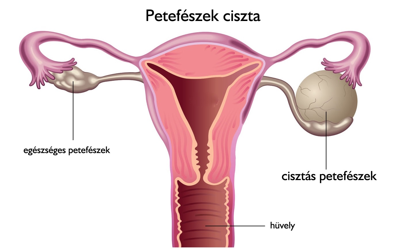 Petefészek ciszták – Nőgyógyászati szülészeti magánrendelés