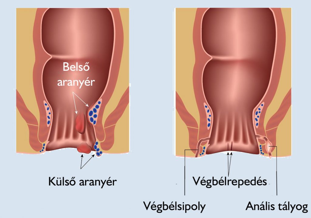 urológia vizsgalat ferfiaknal Prostatitis Ár Ár