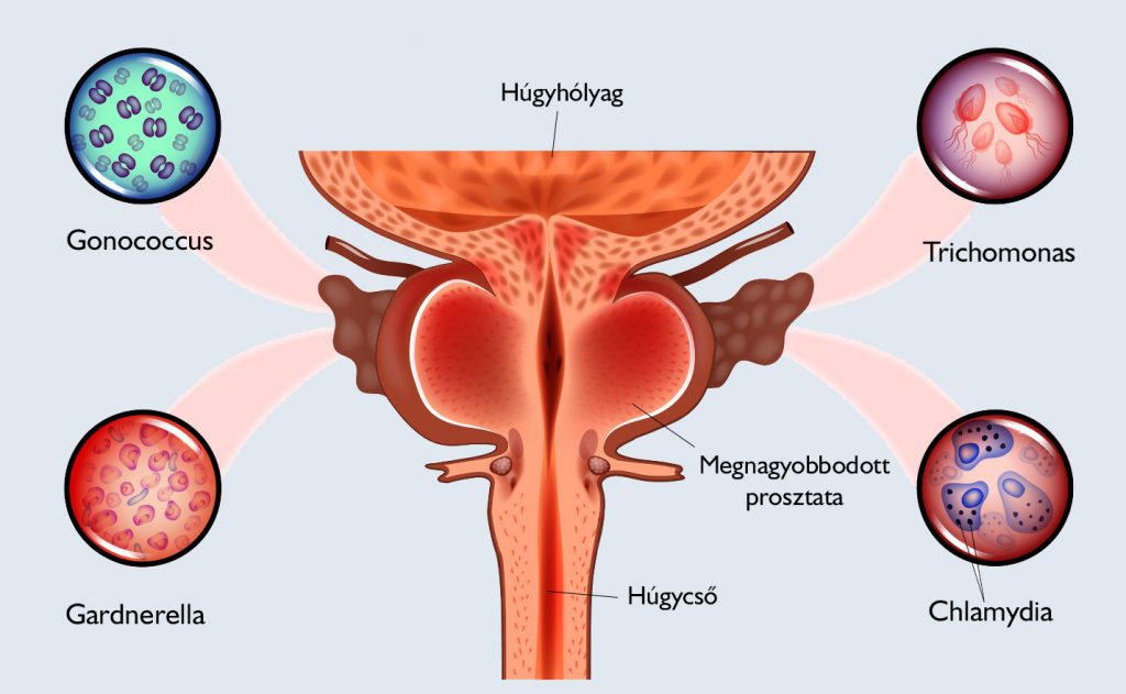 Prostatitis és vörös húgycső Prosztata fibrózis műveletek