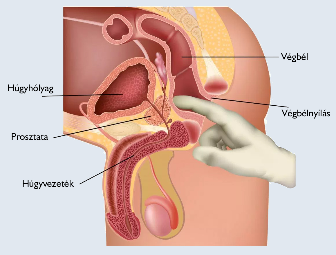 A prosztata adenomectomia
