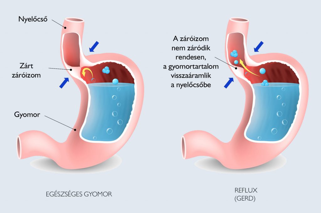 Fogyás reflux miatt, A reflux súlycsökkenést okozhat