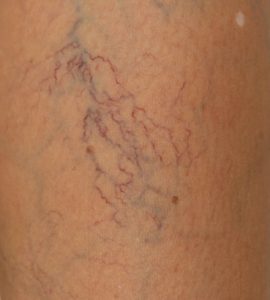 psoriasis worse after giving birth vörös foltok a lábakon viszketnek és fokozódnak