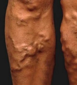 a lábakon visszeres jód kezelje a varikózisos sebeket