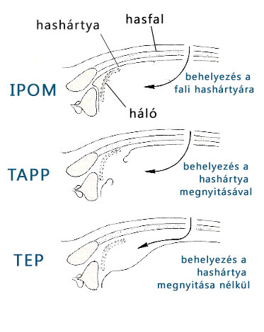 IPOM-TAPP-TEP sérv műtétek