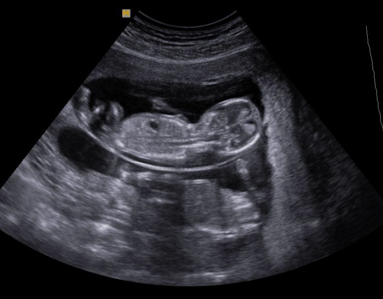 terhessegi-ultrahang-kep