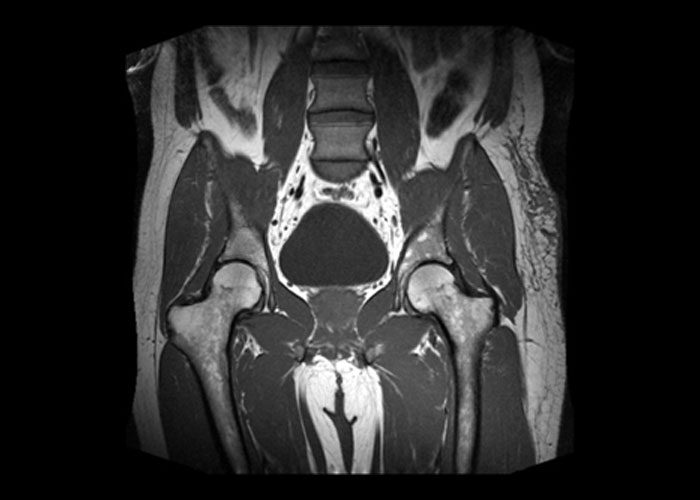MRI kis medence prosztatitissel