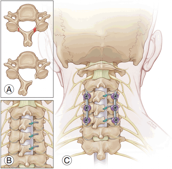 gyulladáscsökkentő a nyaki gerinc osteochondrosisában a nyaki gerinc intervertebrális osteochondrosisa