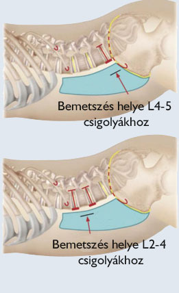 Az ágyéki gerinc gerincszűkülete (ágyéki gerincszűkület) | Tünetek, tanácsok ++