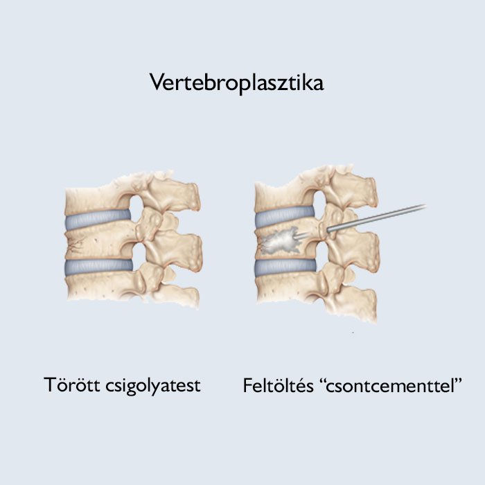vertebroplasztika