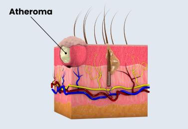 atheroma-1